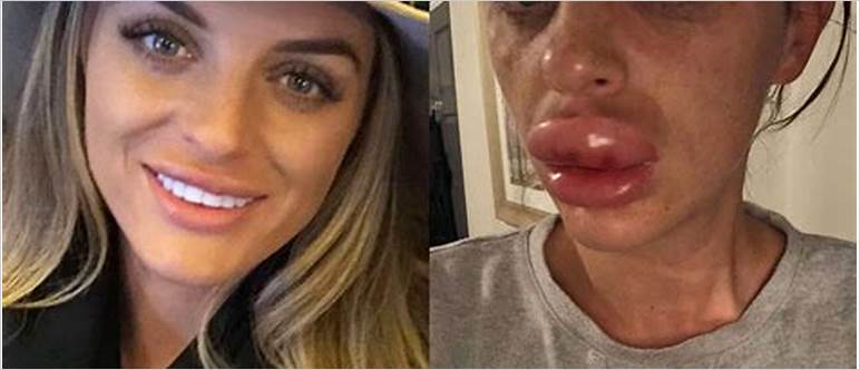 Lip fillers going wrong